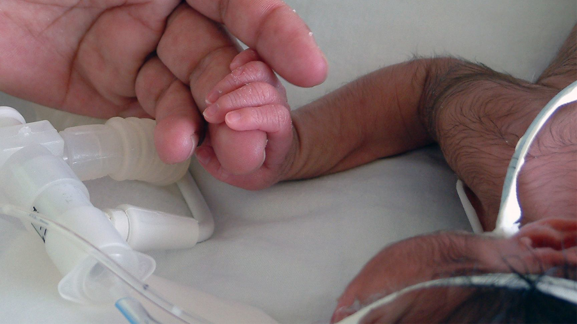 En México se registró el nacimiento de una bebé con cola de casi 6 centímetros de largo