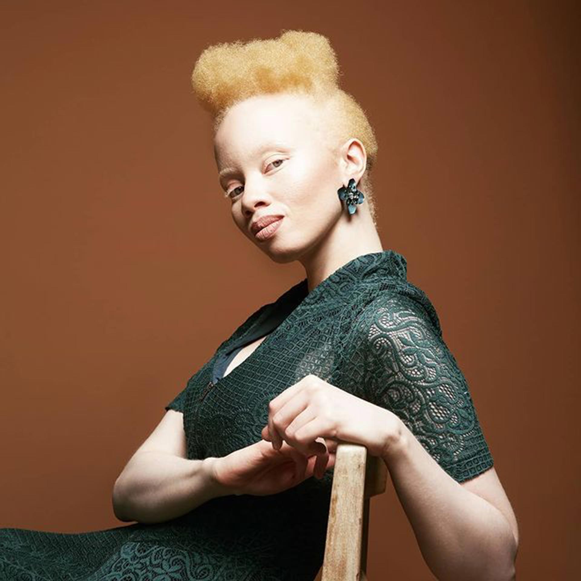 Thando Hopa nació en Sudáfrica, fue descubierta por un diseñador de alta costura y se convirtió en la primera modelo albina en ocupar la tapa de la revista Vogue en 2014