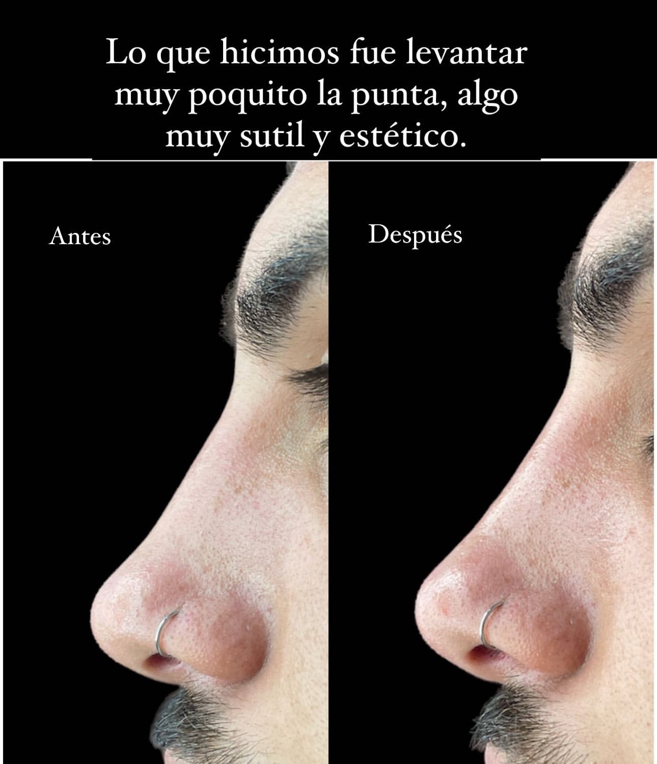 Tomás Holder se hizo un retoque estético en su cara: el antes y el después (Instagram)