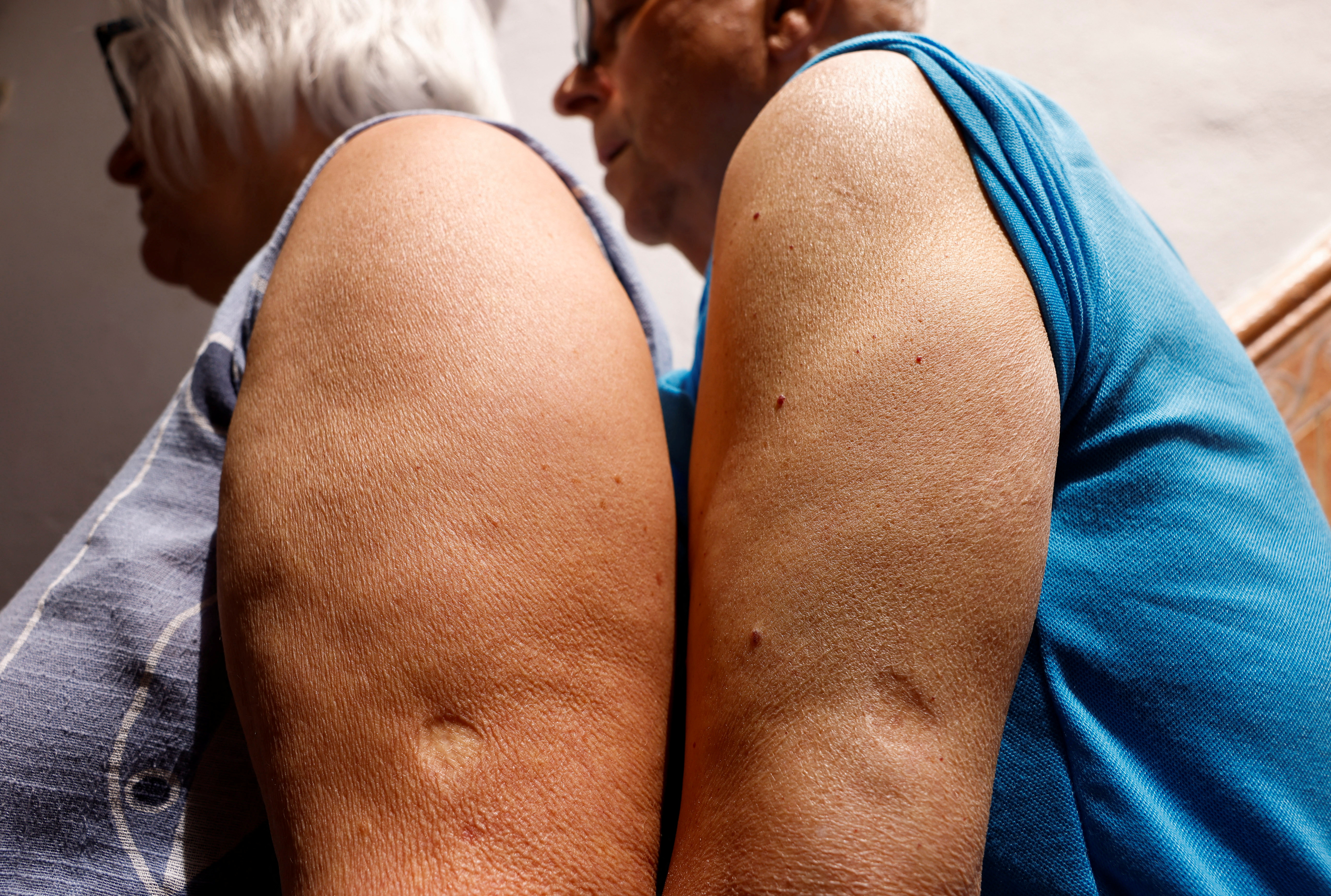 Josefa Espinosa, de 65, y su esposo, Francisco Vivas, de 79, muestran las cicatrices de las vacunas contra la viruela que recibieron de niños (Reuters)