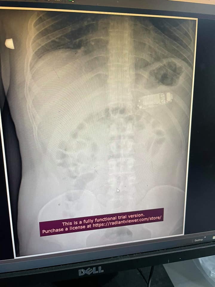 Esta radiografía muestra el celular dentro del cuerpo del hombre. Foto: Facebook Skender Telaku