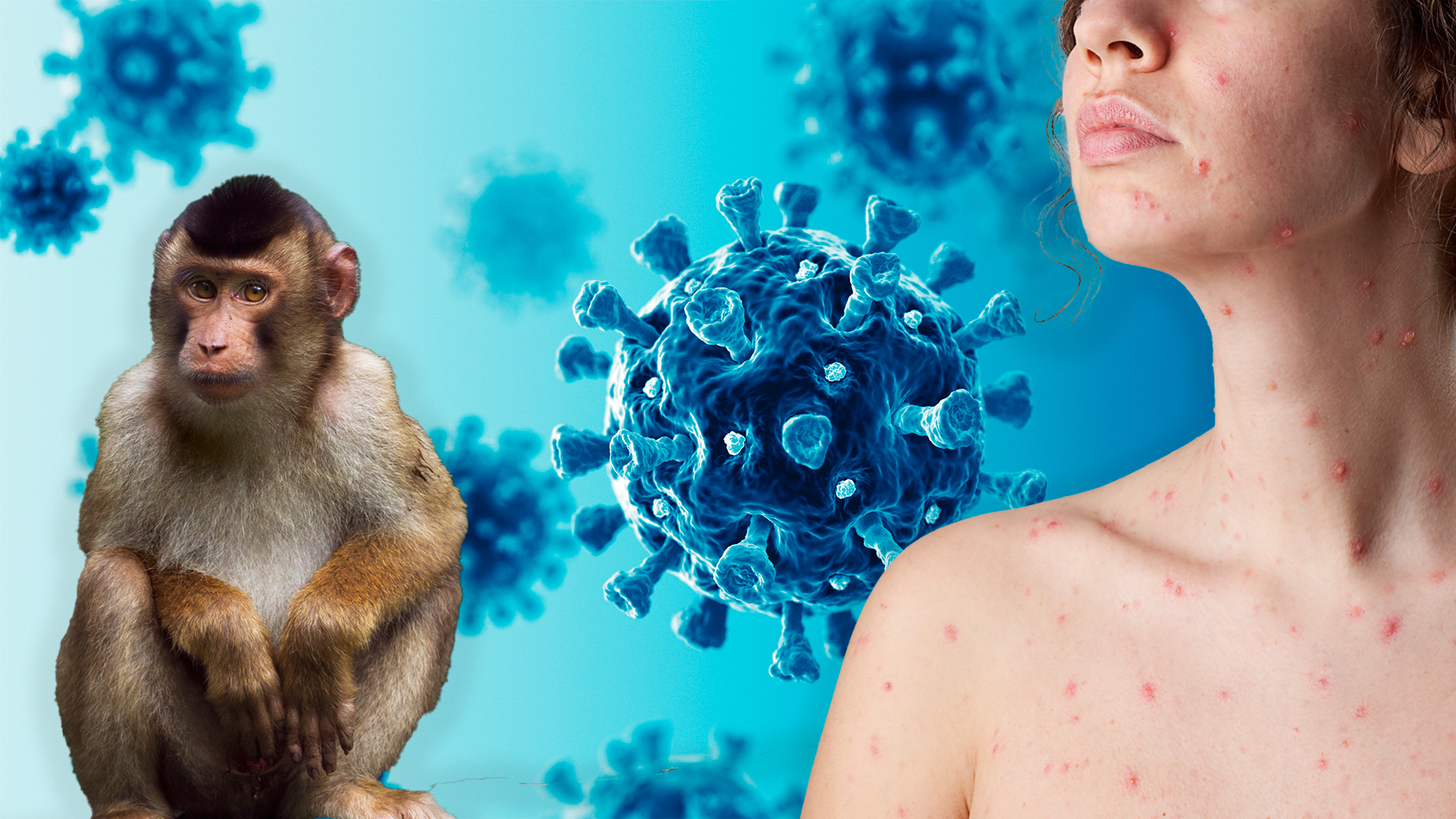 La viruela del mono -que fue detectada por primera vez en el ser humano en 1970- es menos peligrosa y contagiosa que su prima la viruela, erradicada en 1980