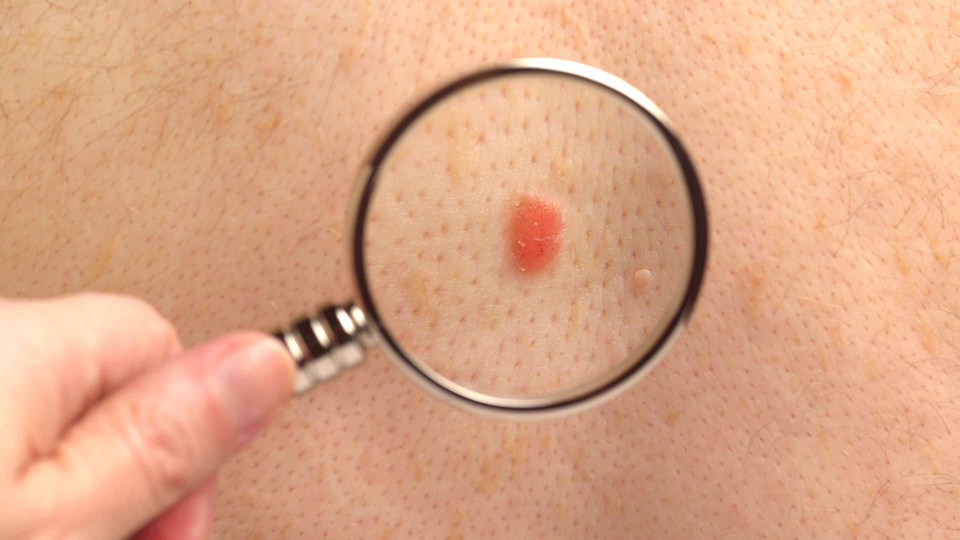 Los cánceres de piel no melanoma y melanoma tienen una tasa muy alta de supervivencia cuando se diagnostica en estadios tempranos (Foto: Getty Images)
