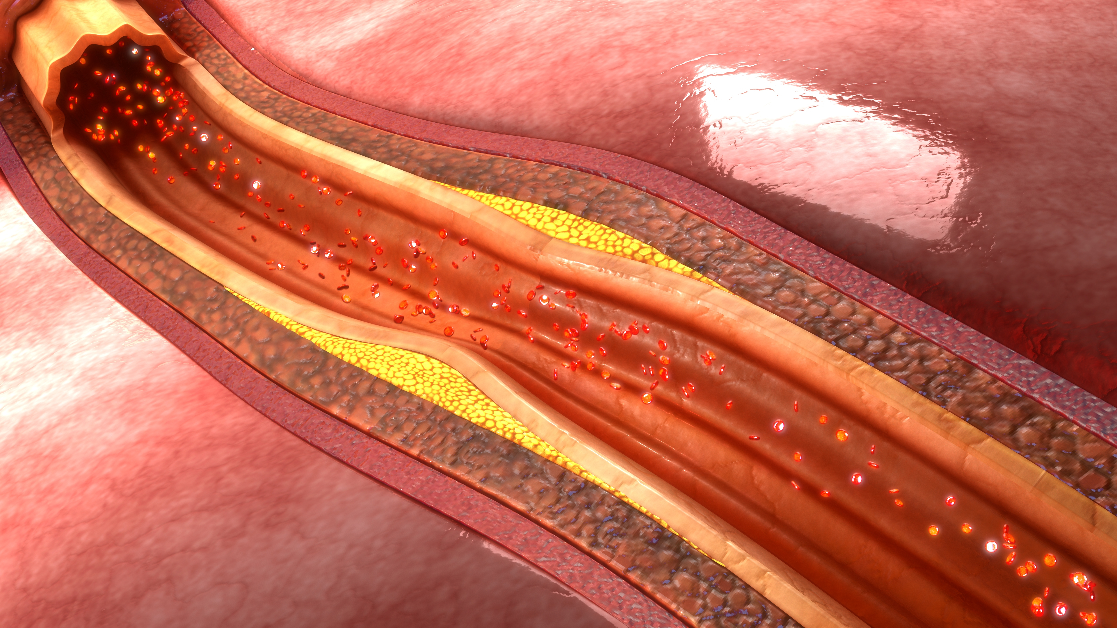 El colesterol LDL causa la acumulación de placas que afectan la circulación de la sangre (Getty)
