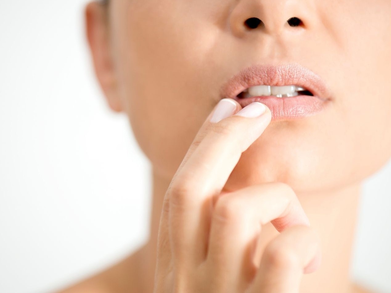 El herpes labial se puede combatir con remedios caseros 
