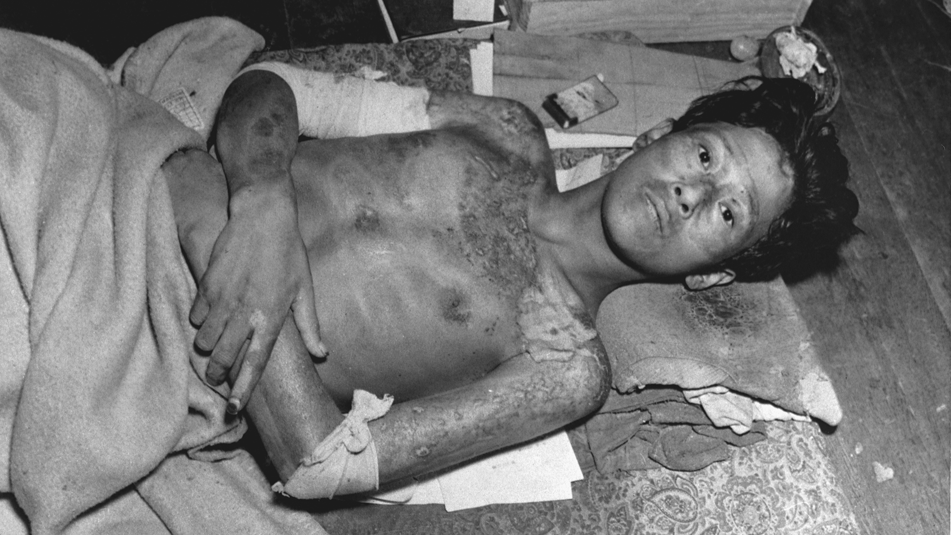 Un joven yace en una colchoneta con quemaduras cubriendo su cuerpo, producto de la la explosión de la bomba atómica sobre Nagasaki, Japón (CORBIS/Corbis vía Getty Images)
