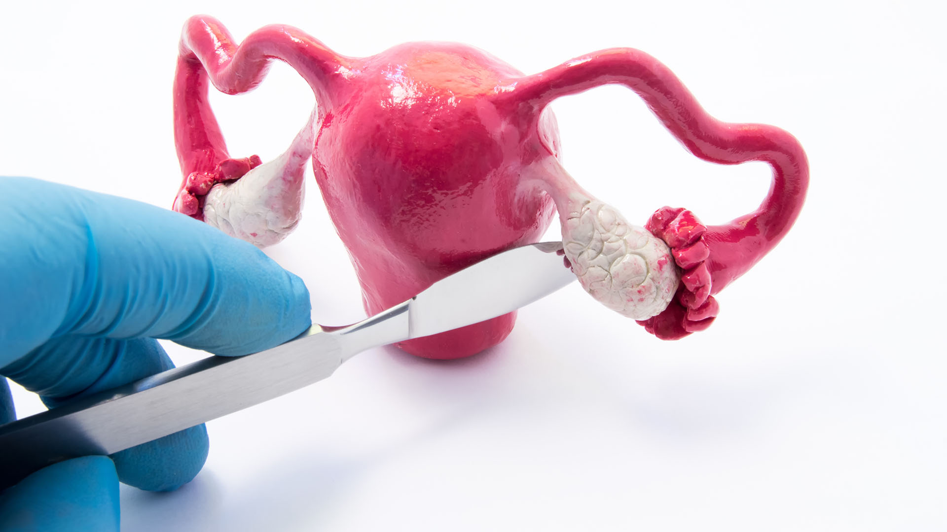 Además de estas mutaciones genéticas, también hay otros genes que se han relacionado con un mayor riesgo de cáncer de ovario, como el gen TP53 y el gen RAD51C