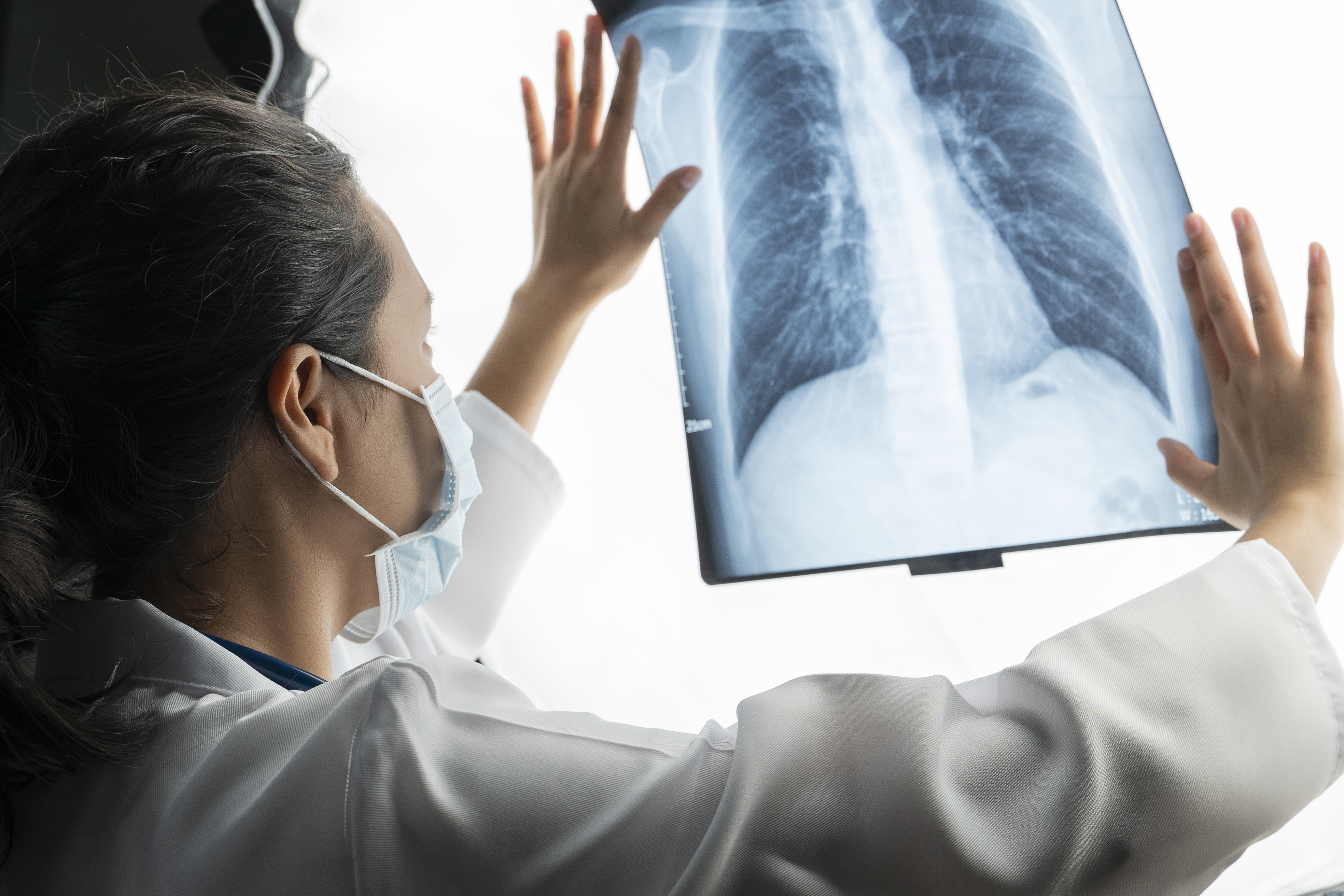 Si el cáncer de pulmón es diagnosticado a tiempo, las probabilidades de supervivencia pueden alcanzar el 90% (Gettyimages)