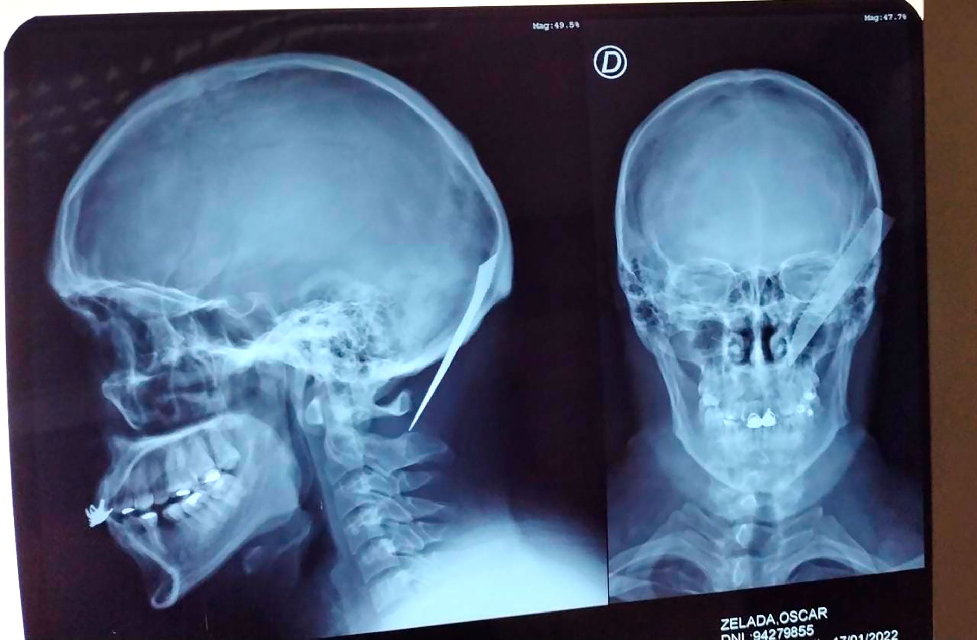 La radiografía del cráneo de Oscar