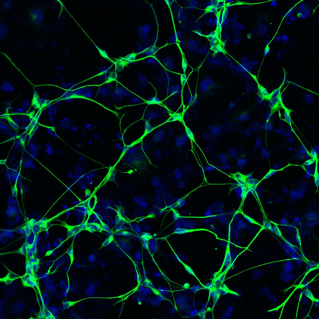 En Estados Unidos y Suecia, desarrollaron una prueba para detectar un nuevo marcador de la neurodegeneración del Alzheimer/Archivo