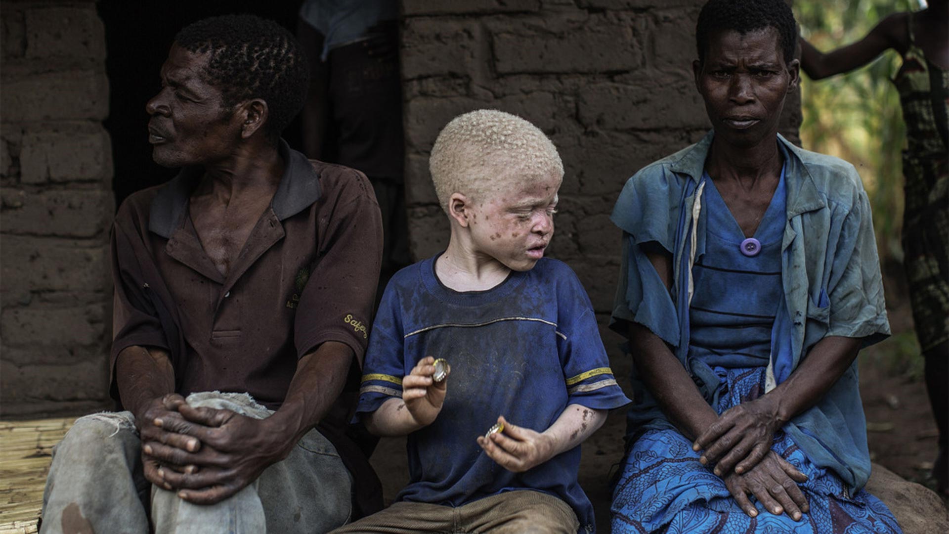 Las tradiciones mágicas y las brujerías terminó por difundir la idea de que un trozo de un albino podría garantizar a otros suerte, riqueza y buena fortuna. Así empezó la persecución, el secuestro, la mutilación y el homicidio de estas víctimas indefensas (AFP)
