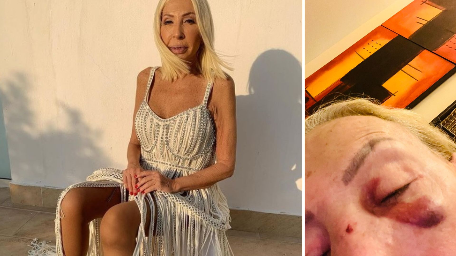 Laura Bozzo had an accident and her face shows the aftermath.  |  Twitter @laurabozzo