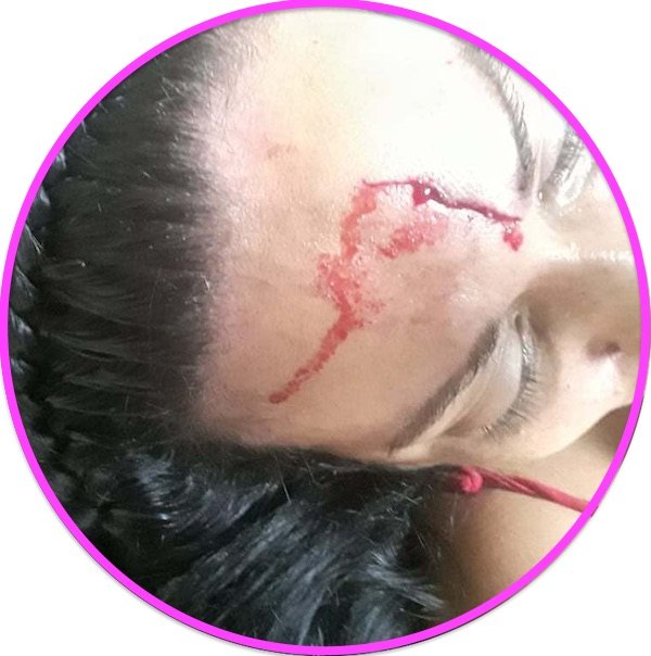 Así quedó la frente de Lía luego de ser tajeada.