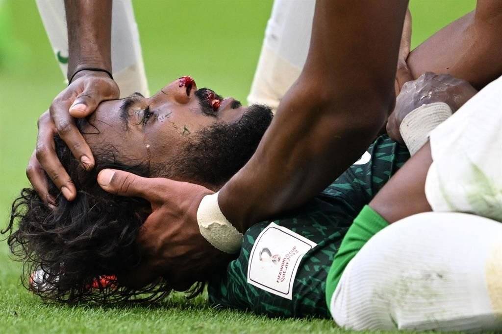Yasser Al-Shahrani con la mirada desorbitada tras la terrible lesión que sufrió. Foto:@laloestralop