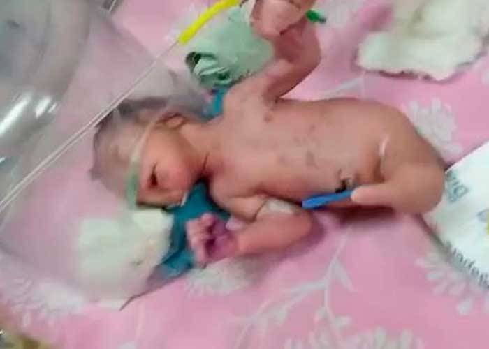 Los médicos creen que este suceso se registró porque no se completó su fase de desarrollo. (Foto: tn8.tv)