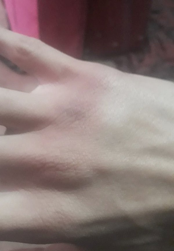 Con lesiones en las manos quedó el muchacho luego de la agresión.