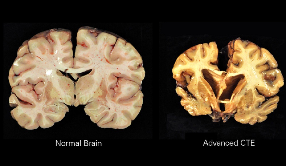 NFL data: Concussions up 18 percent in 2022