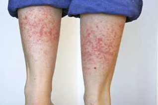 The rash suffered by the dog walker after coming into contact with the plant