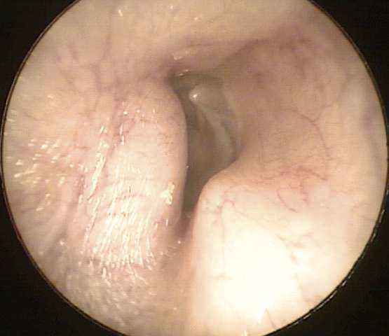 Partial surfer's ear, with bony swellings starting to narrow the ear canal