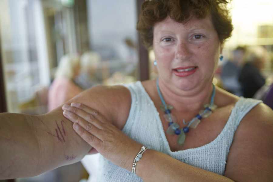 Long distance swimmer Wendy Trehiou, pictured showing jellyfish 'burns' on her arm, was stung by several jellyfish during her record-breaking St Malo to Jersey swim this summer