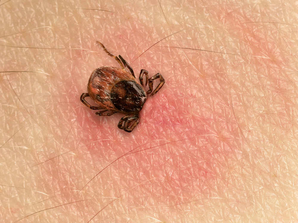 The most common signs of lyme disease are a rash and flu-like symptoms