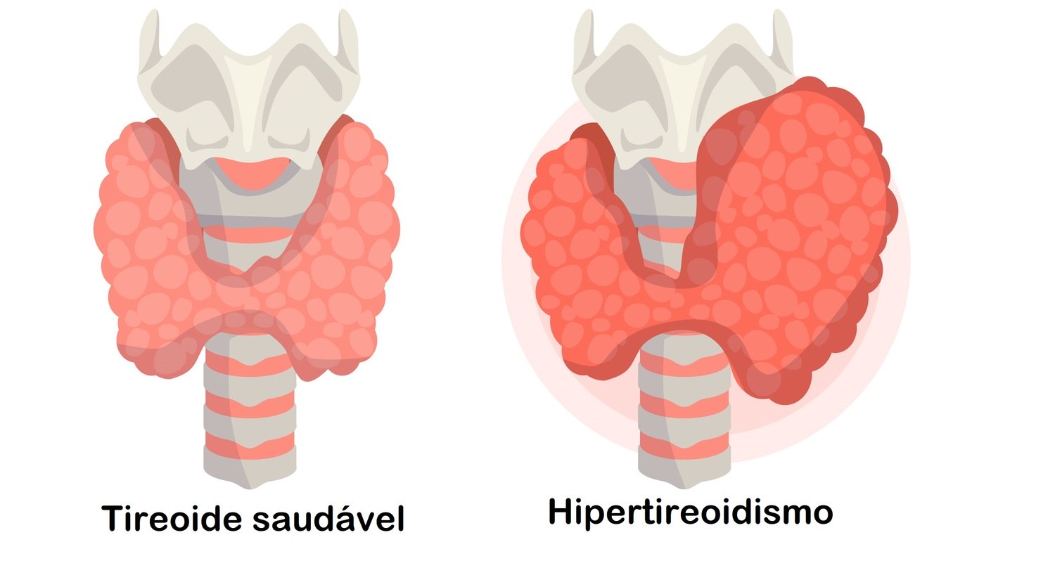Conheça os sintomas que podem indicar algum problema na tireoide – Noticias  R7, image size:1500x798
