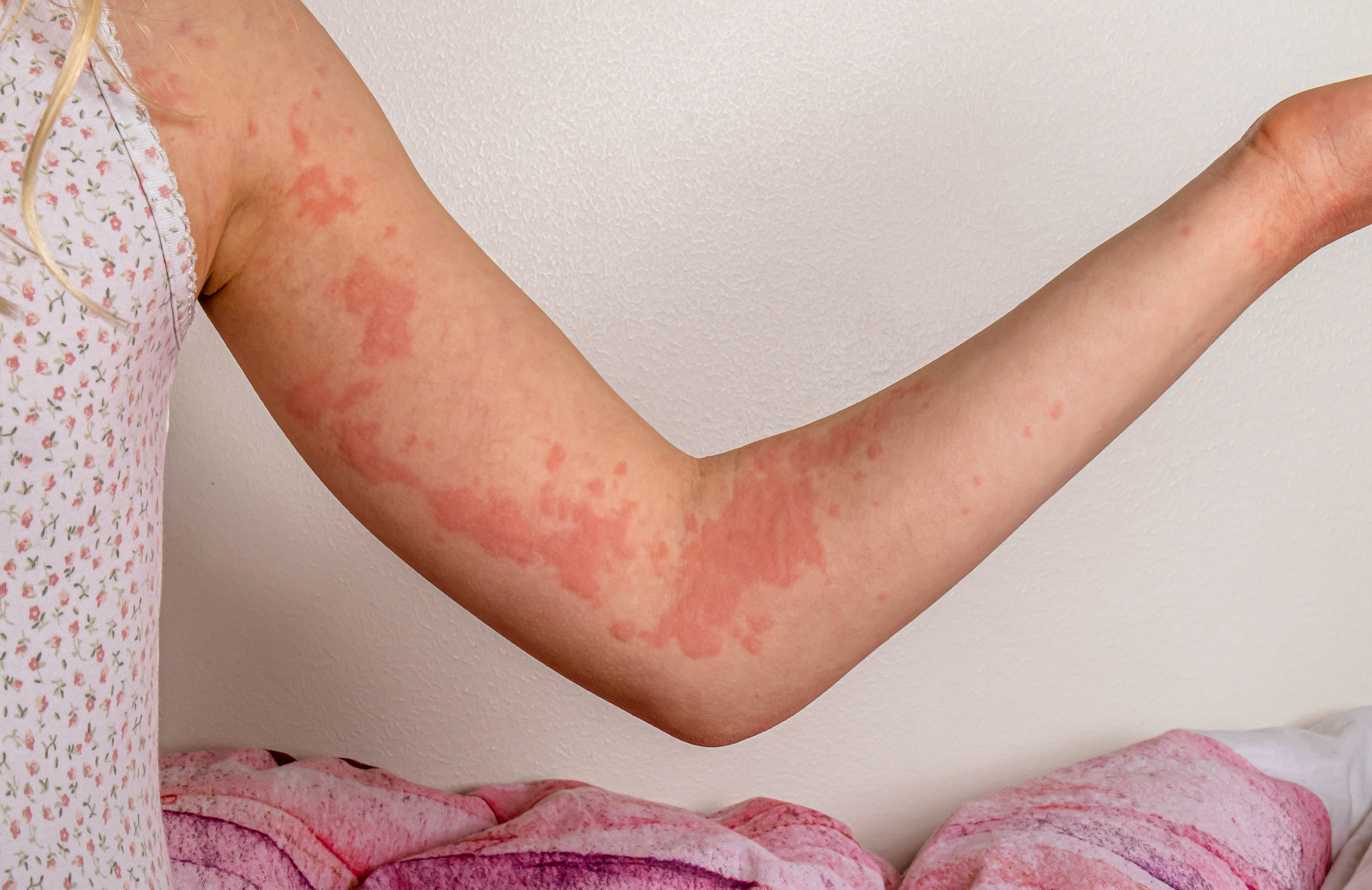 What causes hives and how dangerous can they be? A nurse practitioner  explains.