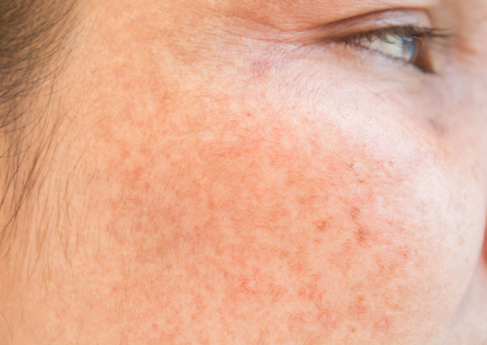 Q&A: What dark spots on skin and what works to fade them?
