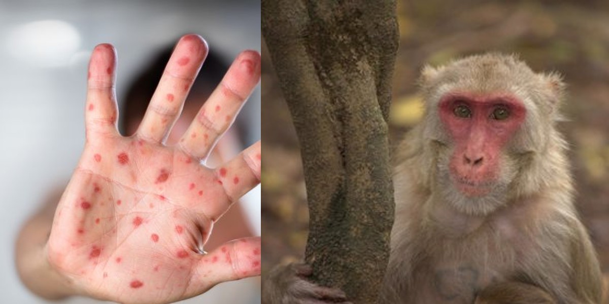 Cómo saber si es viruela del mono u otra enfermedad con síntomas similares en la piel