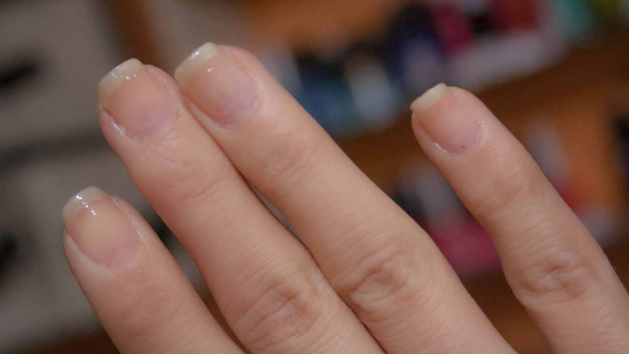 Manchas blancas en las uñas cuáles son las causas y tratamiento