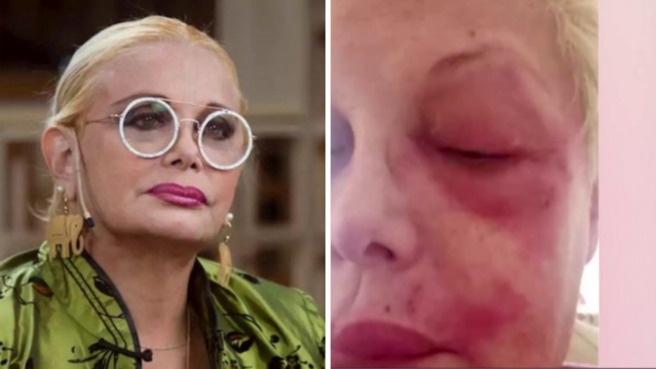 Puedo Perder Un Ojo El Grave Momento De Salud Que Atraviesa Carmen Barbieri Radio Mitre