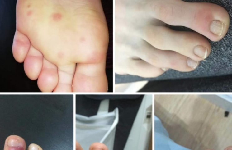 Coronavirus: detectaron lesiones dermatológicas en los pies de niños y adolescentes
