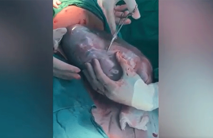 Video el increíble parto de un bebé dentro del saco amniótico