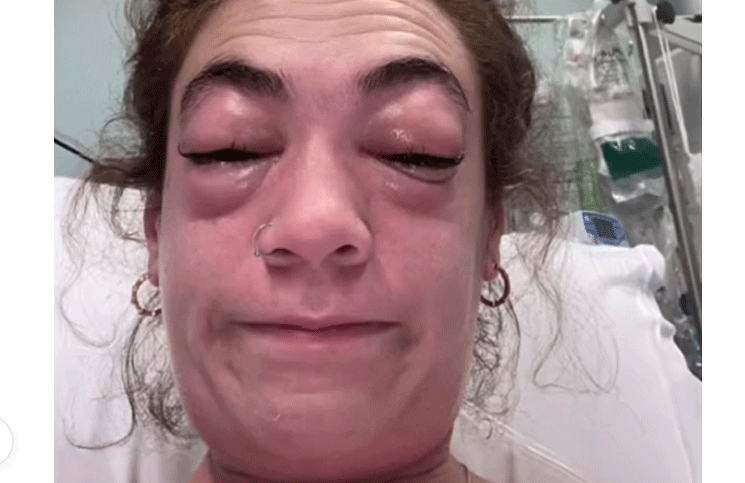 Se puso extensiones de pestañas y el resultado se hizo viral: "Descubrí una nueva alergia"