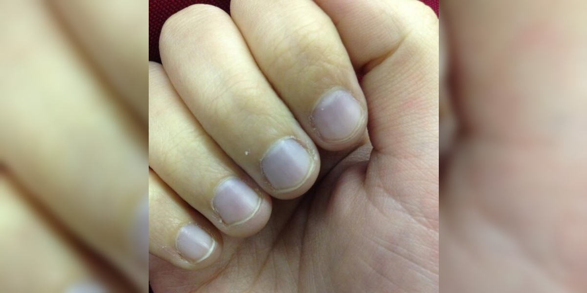 Aprender acerca 39+ imagen uñas violetas por el frio