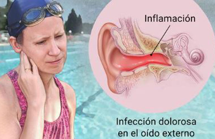 La Otitis Externa Sintomas Causas Y Tratamiento De La Enfermedad La 100