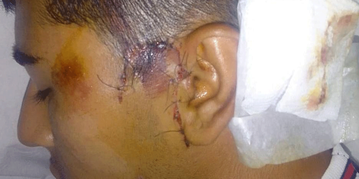 Horror en Santiago del Estero: una patota golpeó a un joven y le atravesó un tornillo de la mejilla hasta la oreja