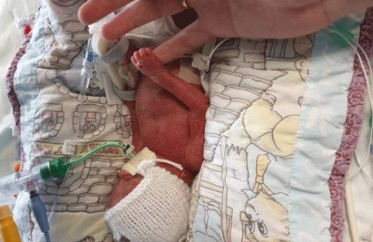 Nació de 23 semanas, tenía el tamaño de un control remoto y logró sobrevivir