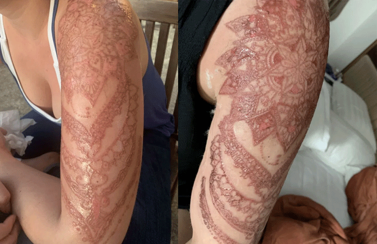 El tatuaje de henna se llenó de ampollas
