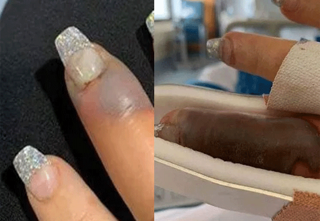 Se le puso morado el dedo después de hacerse las uñas y casi lo pierde |  Mia FM