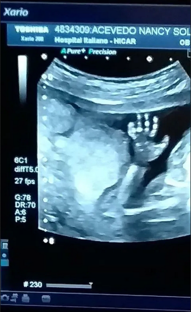 Furor Por La Ecografia De Un Bebe Que Saluda A Su Mama La 100