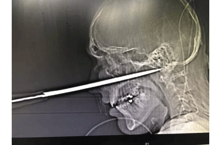 El cuchillo entró por su cara y se salvó por 1 milímetro