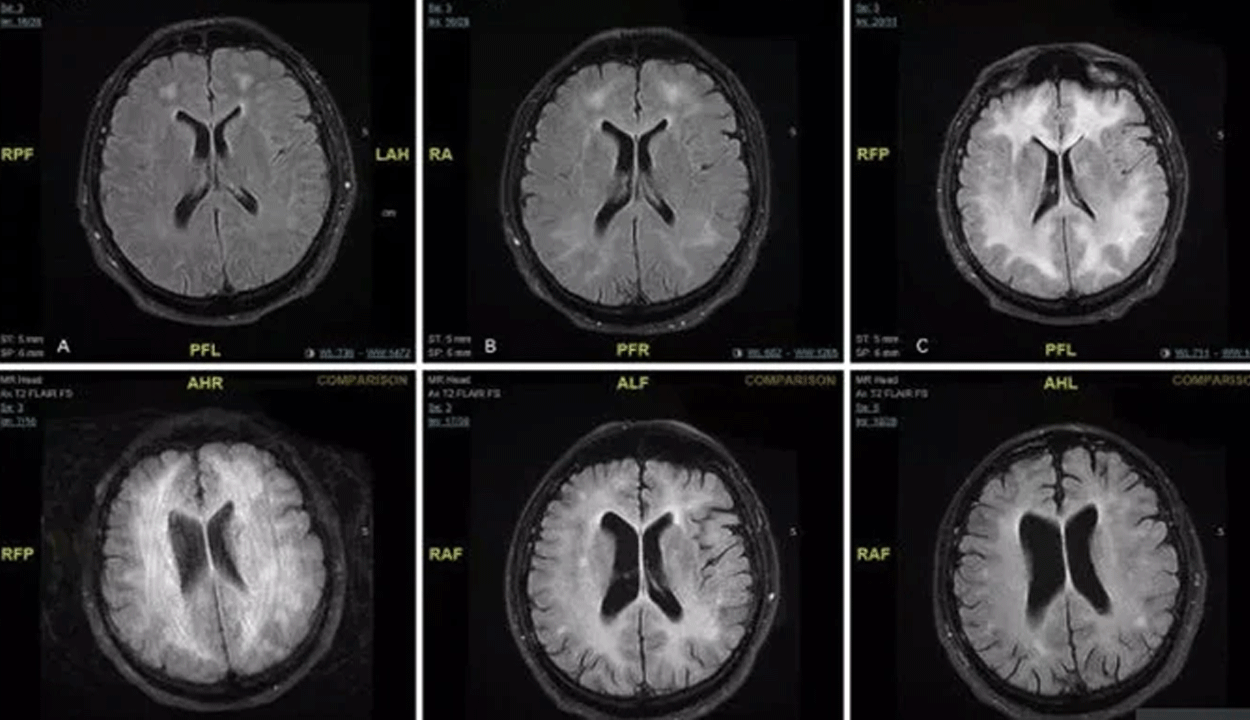 Las imágenes que muestran cómo la cocaína "come" el cerebro de un adicto