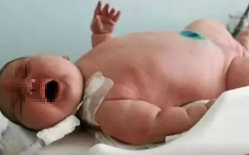 Un Bebe Recien Nacido Rompio Un Record Mundial Es El Mas Grande Y Pesa 18 Kilos Radio Mitre