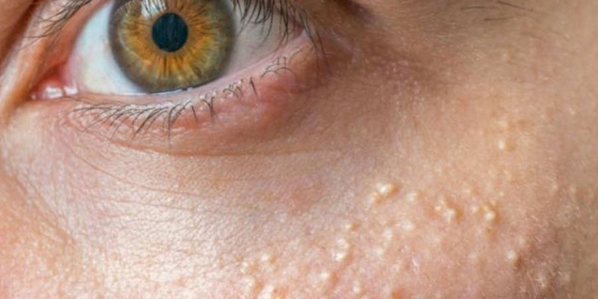 Granos en la cara: por qué salen más cerca de los ojos  