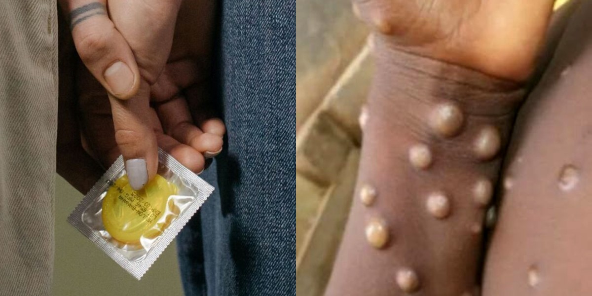 Advierten que el uso del preservativo “no evita el contagio” de viruela de mono