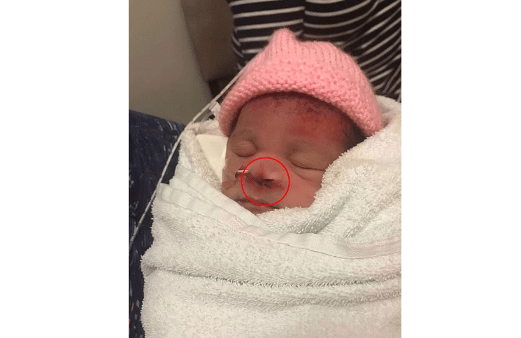 Valencia recién nacida con el corte debajo de la nariz
Foto: Daily Mail
