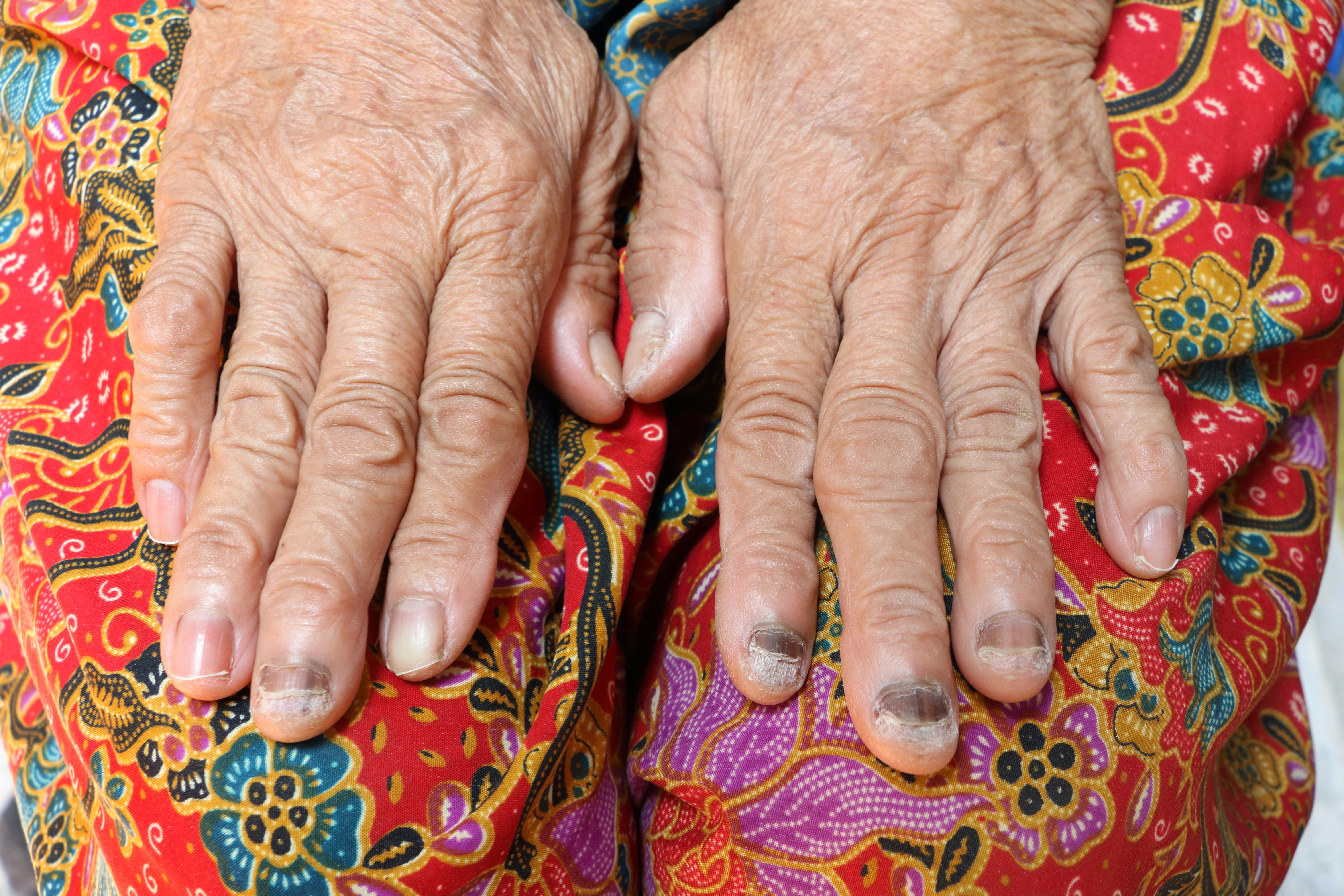 Hongos en las uñas  Síntomas y causas  Mayo Clinic