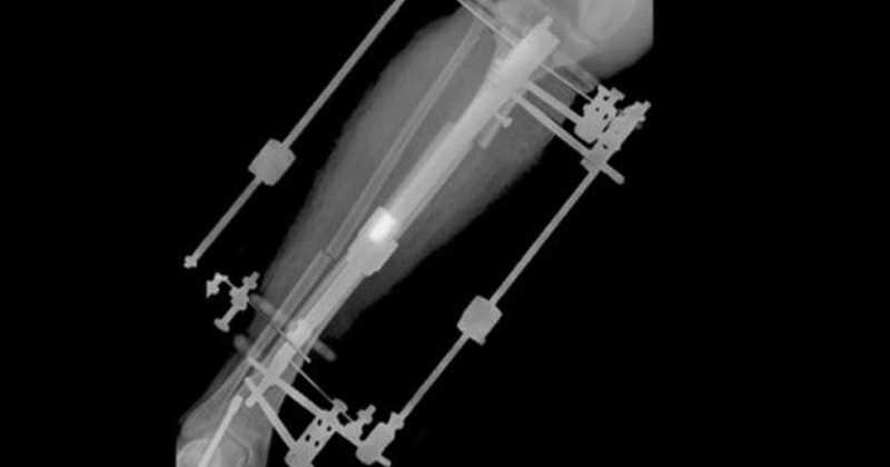 El dispositivo fijador externo permite alargar la tibia un mil&iacute;metro al d&iacute;a.