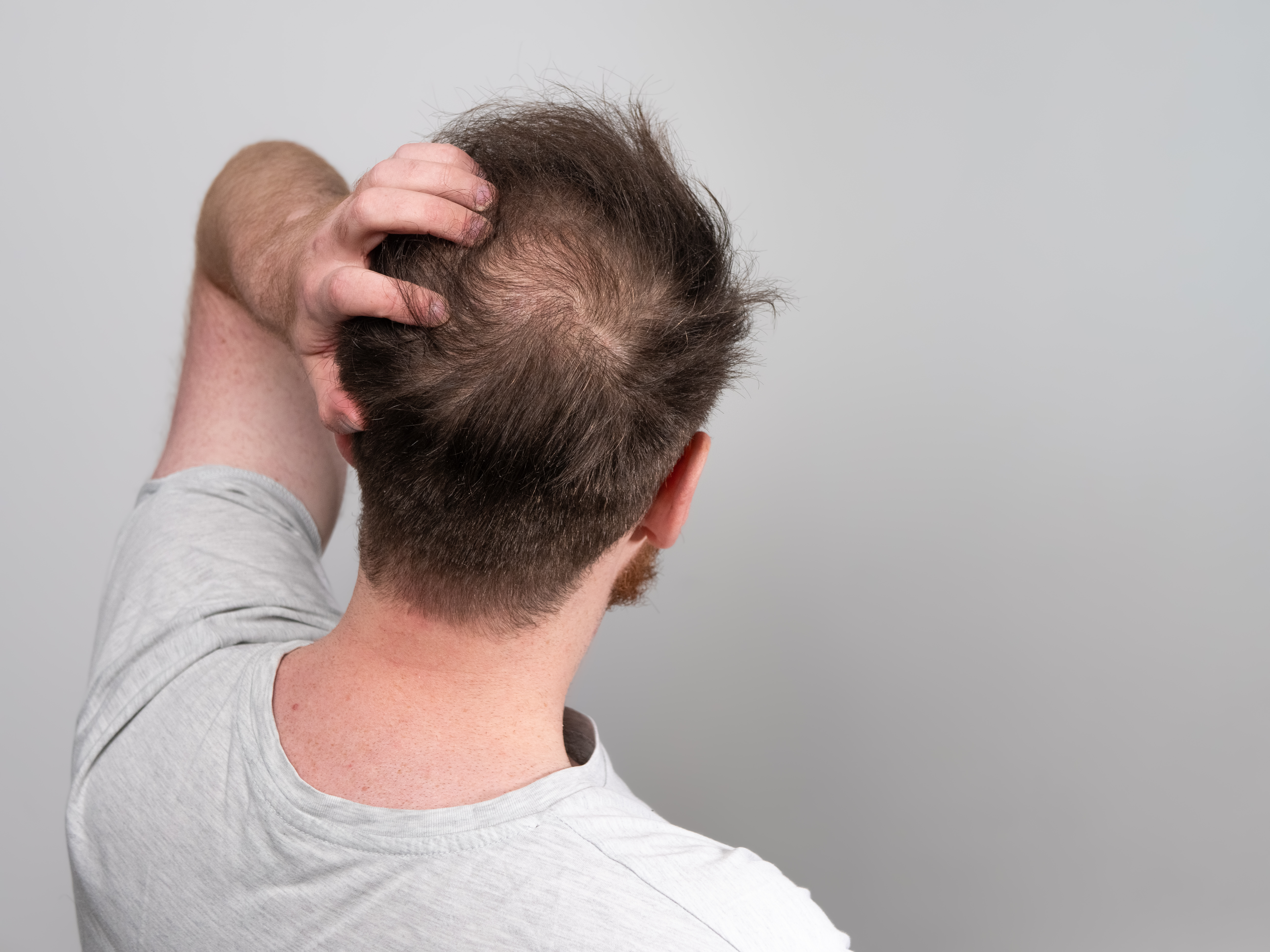 Hombres: esto es lo que deben hacer para estimular el crecimiento cabello